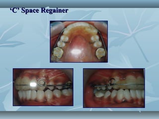 ‘‘C’ Space RegainerC’ Space Regainer
 