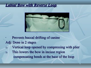 Labial Bow with Reverse LoopLabial Bow with Reverse Loop
• Prevents buccal drifting of caninePrevents buccal drifting of canine
Adj: Done in 2 stagesAdj: Done in 2 stages
1)1) Vertical loop opened by compressing with plierVertical loop opened by compressing with plier
2)2) This lowers the bow in incisor regionThis lowers the bow in incisor region
compensating bends at the base of the loopcompensating bends at the base of the loop
 