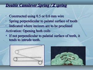 Simple Z Spring Basic removable appliance design | PPT