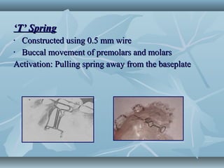 ‘‘T’ SpringT’ Spring
• Constructed using 0.5 mm wireConstructed using 0.5 mm wire
• Buccal movement of premolars and molarsBuccal movement of premolars and molars
Activation: Pulling spring away from the baseplateActivation: Pulling spring away from the baseplate
 