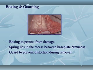 Boxing & GuardingBoxing & Guarding
• Boxing to protect from damageBoxing to protect from damage
• Spring lies in the recess between baseplate &mucosaSpring lies in the recess between baseplate &mucosa
• Guard to prevent distortion during removalGuard to prevent distortion during removal
 