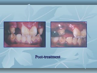 Removable Design Basic removable appliance design | PPT