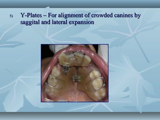 5)5) Y-Plates – For alignment of crowded canines byY-Plates – For alignment of crowded canines by
saggital and lateral expansionsaggital and lateral expansion
 