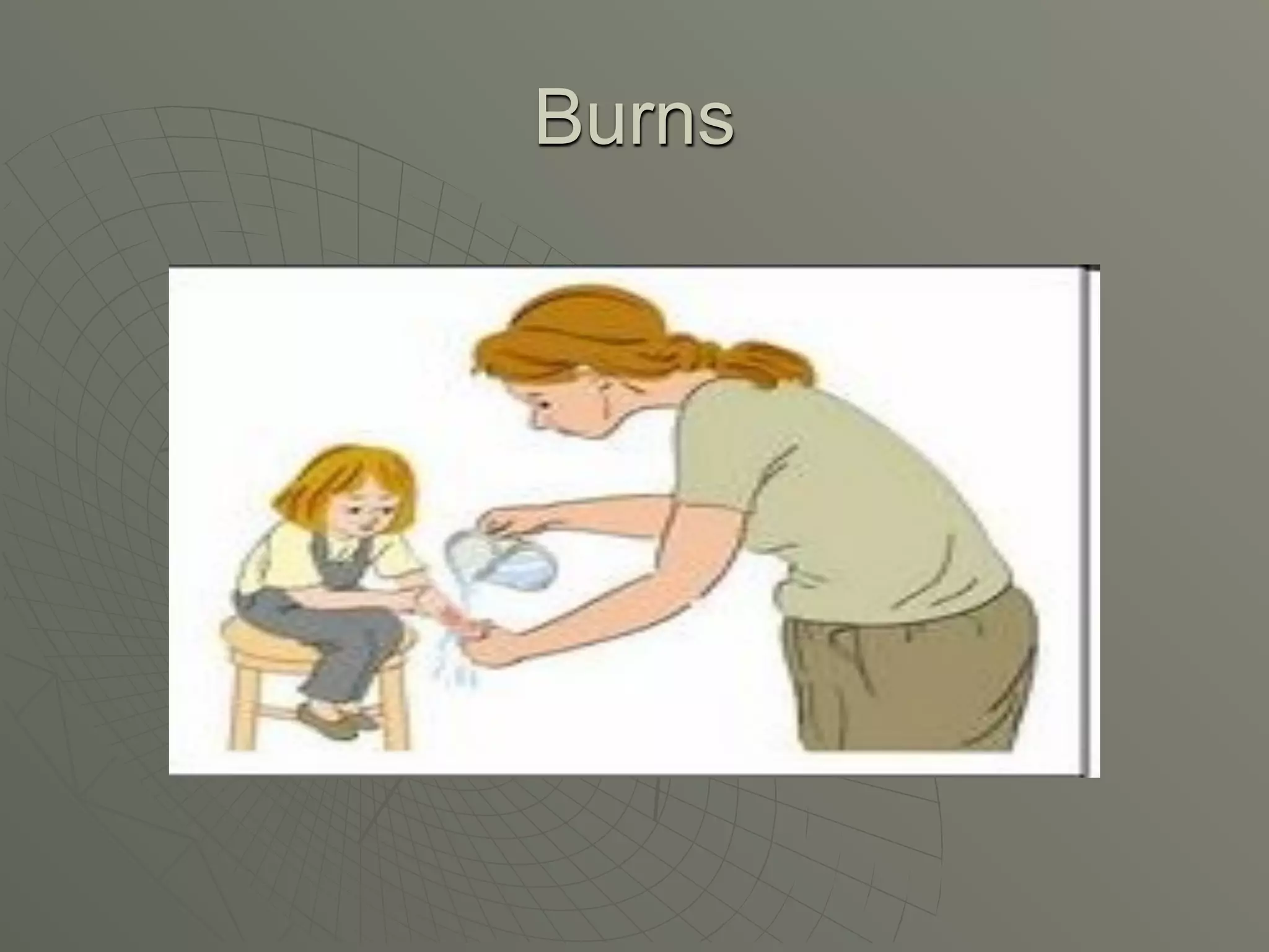 Burns
 