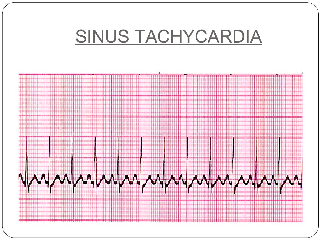 Basics of ECG