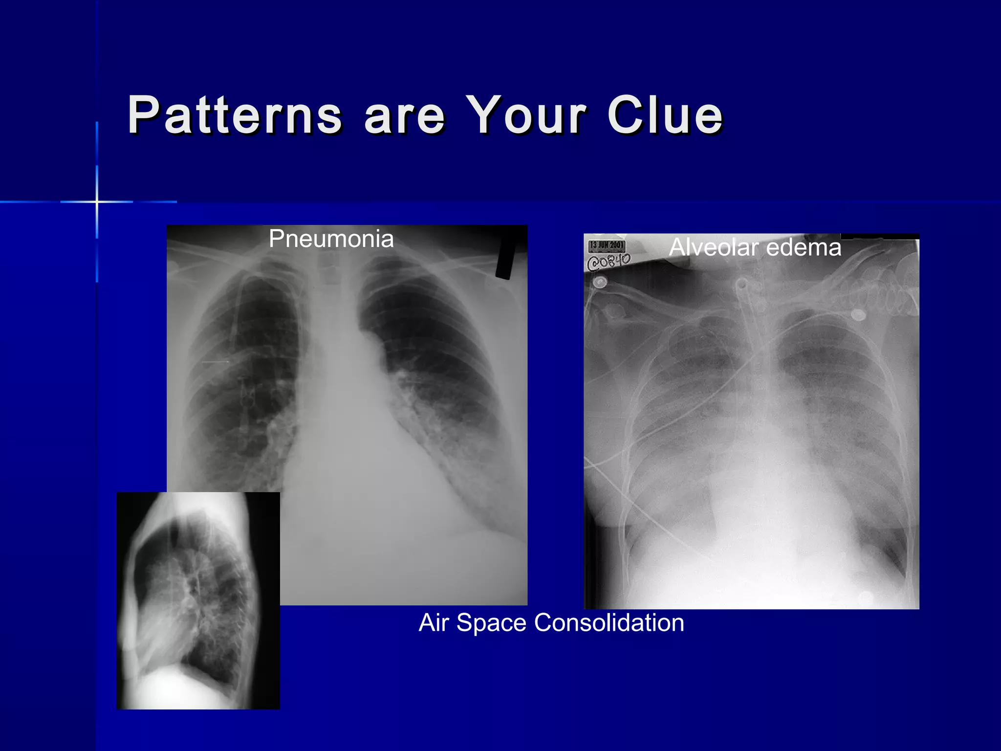 Patterns are Your CluePatterns are Your Clue
Air Space Consolidation
Pneumonia Alveolar edema
 