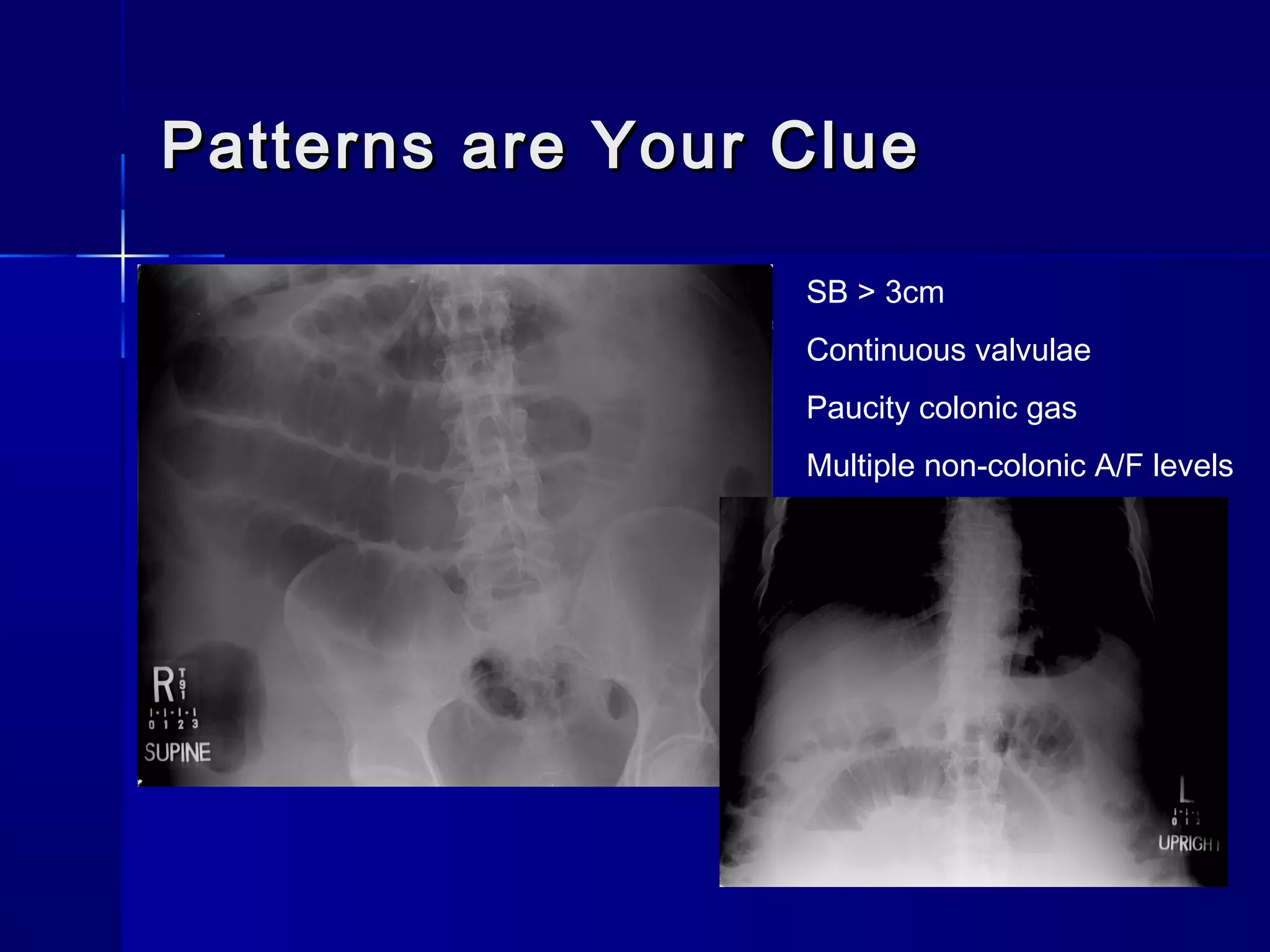 Patterns are Your CluePatterns are Your Clue
SB > 3cm
Continuous valvulae
Paucity colonic gas
Multiple non-colonic A/F levels
 