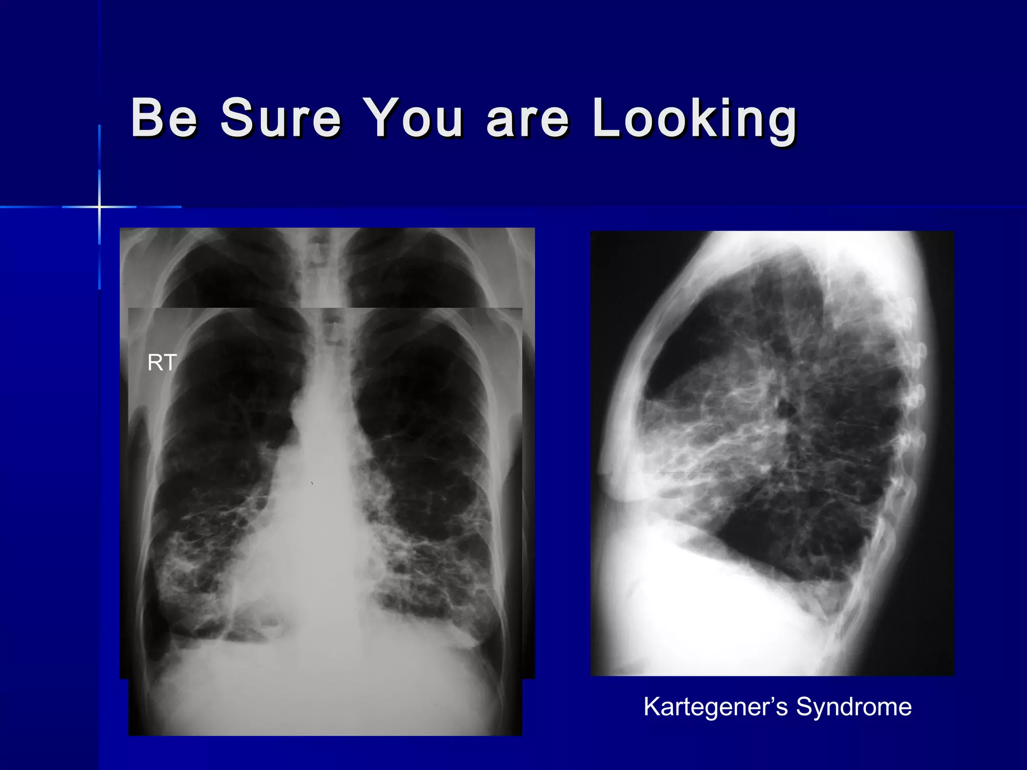 Be Sure You are LookingBe Sure You are Looking
Kartegener’s Syndrome
RT
 