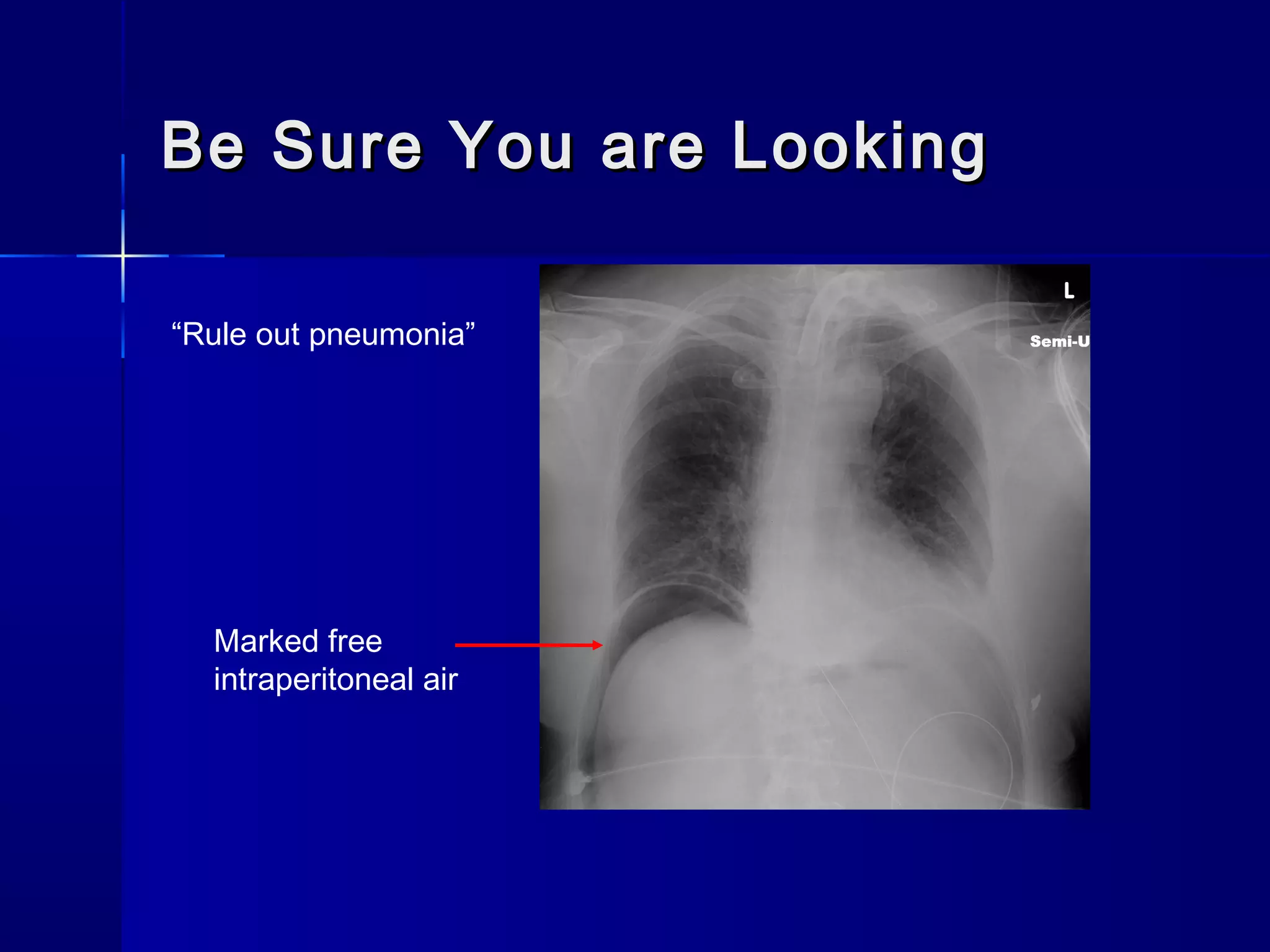 Be Sure You are LookingBe Sure You are Looking
“Rule out pneumonia”
Marked free
intraperitoneal air
 