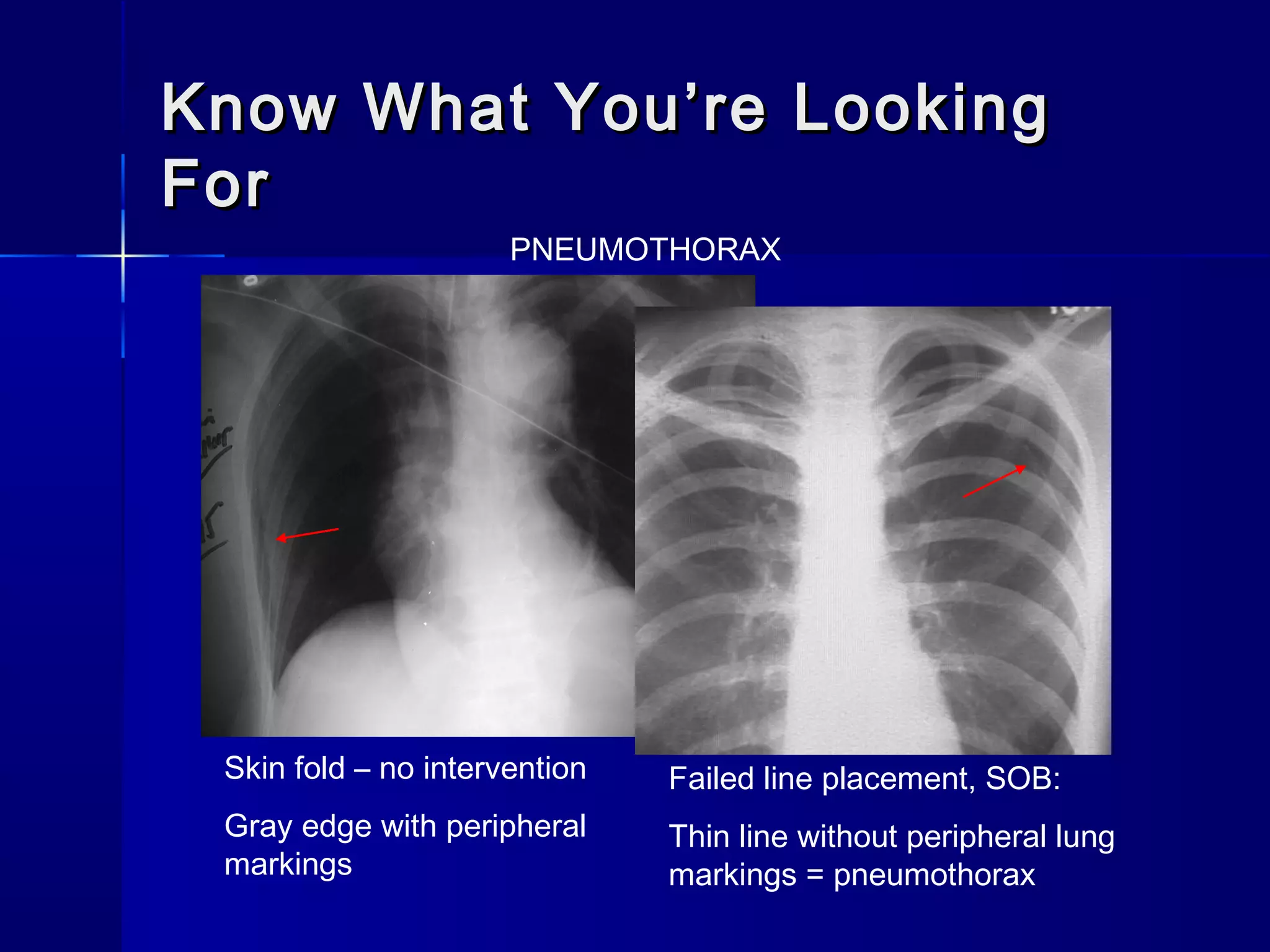 Know What You’re LookingKnow What You’re Looking
ForFor
Skin fold – no intervention
Gray edge with peripheral
markings
Failed line placement, SOB:
Thin line without peripheral lung
markings = pneumothorax
PNEUMOTHORAX
 