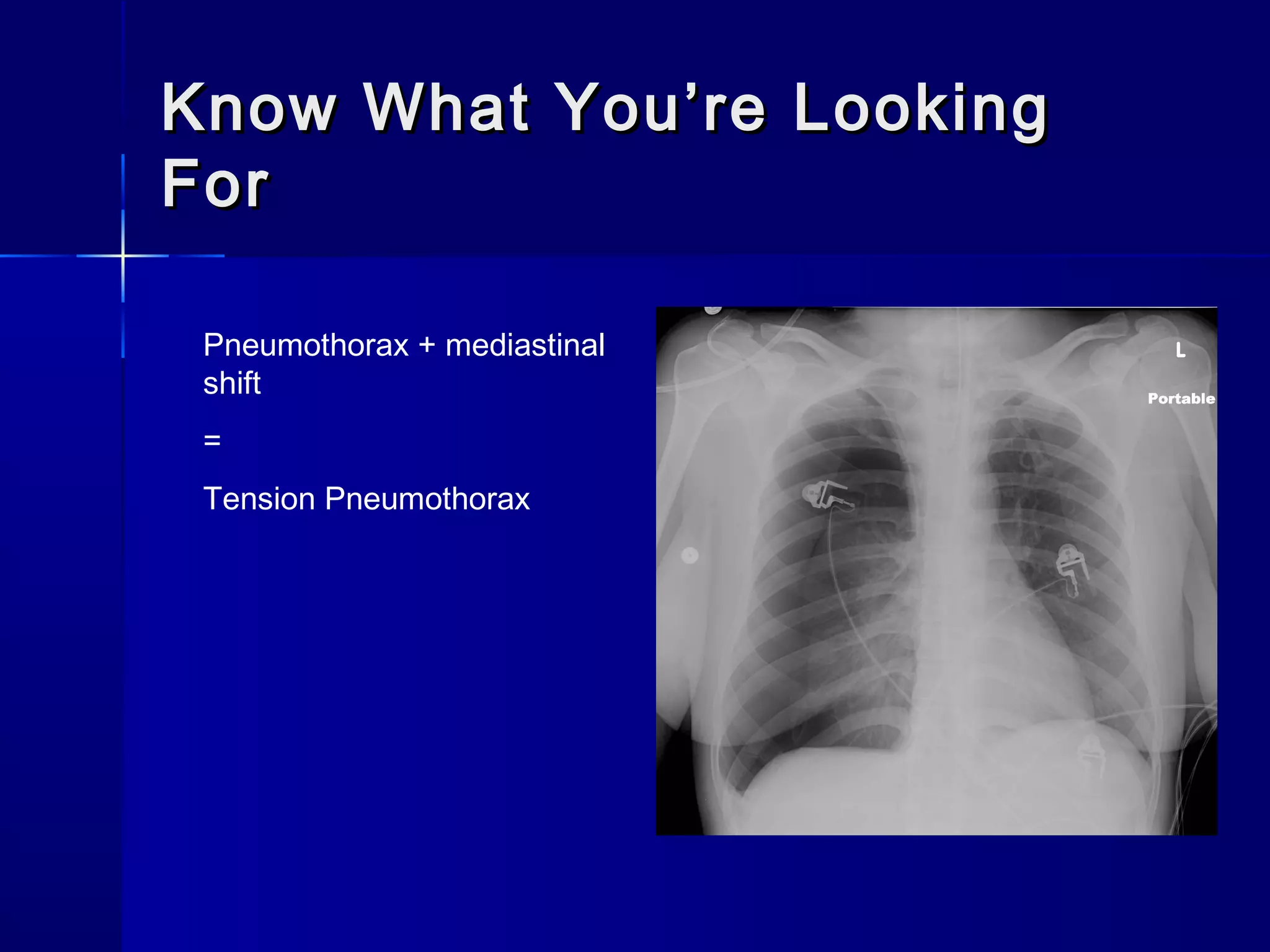 Know What You’re LookingKnow What You’re Looking
ForFor
Pneumothorax + mediastinal
shift
=
Tension Pneumothorax
 