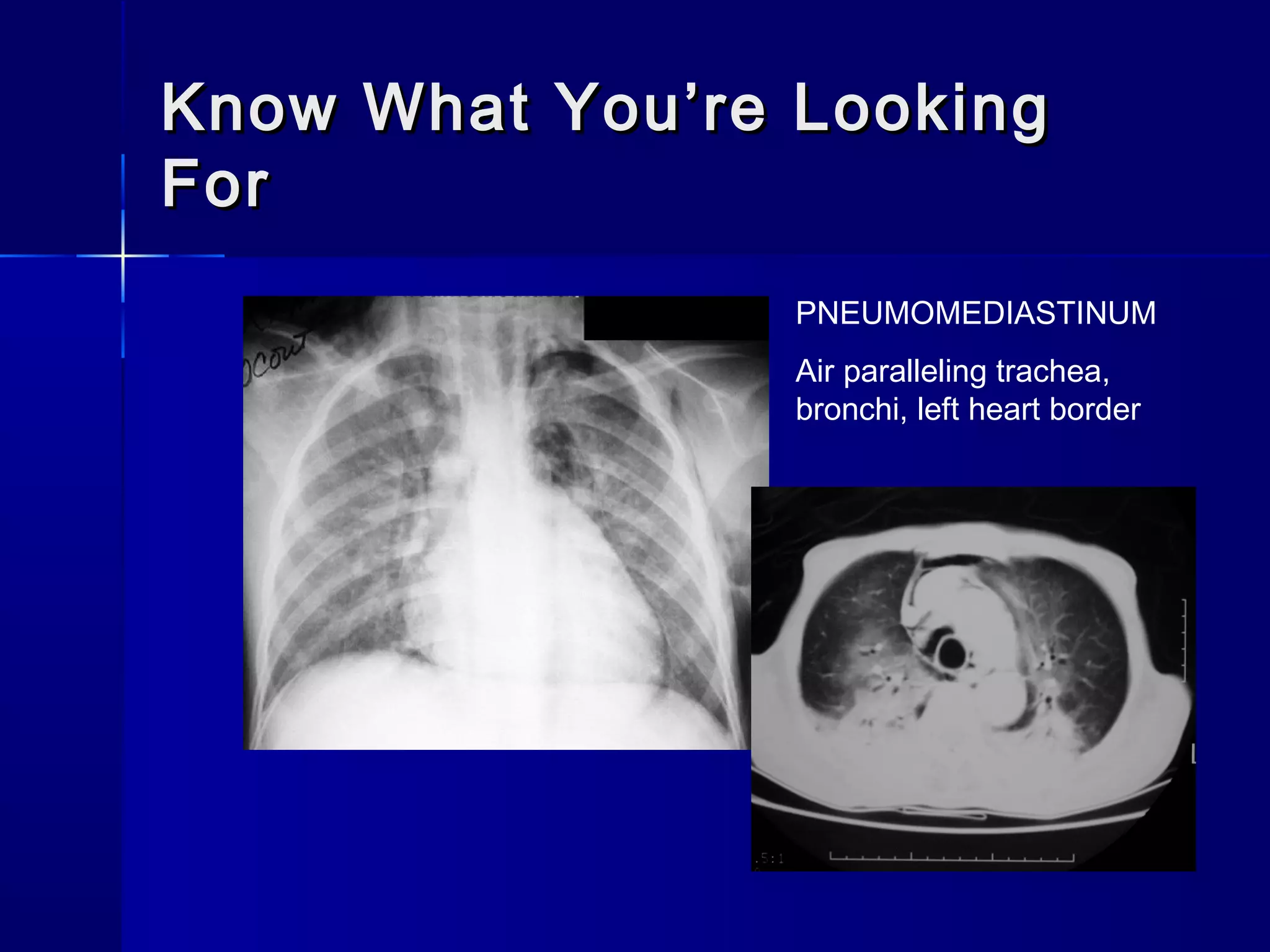 Know What You’re LookingKnow What You’re Looking
ForFor
PNEUMOMEDIASTINUM
Air paralleling trachea,
bronchi, left heart border
 