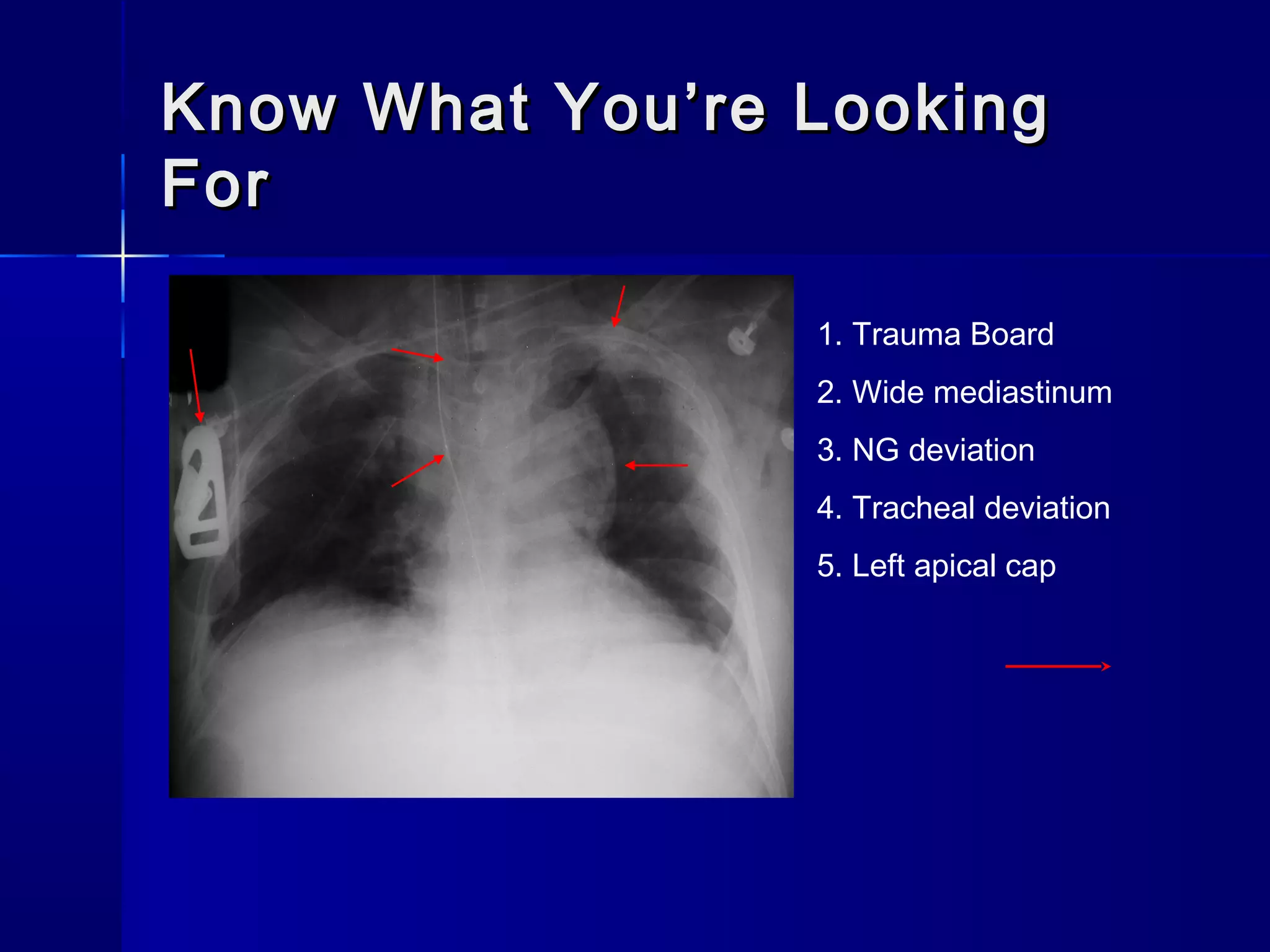 Know What You’re LookingKnow What You’re Looking
ForFor
1. Trauma Board
2. Wide mediastinum
3. NG deviation
4. Tracheal deviation
5. Left apical cap
 