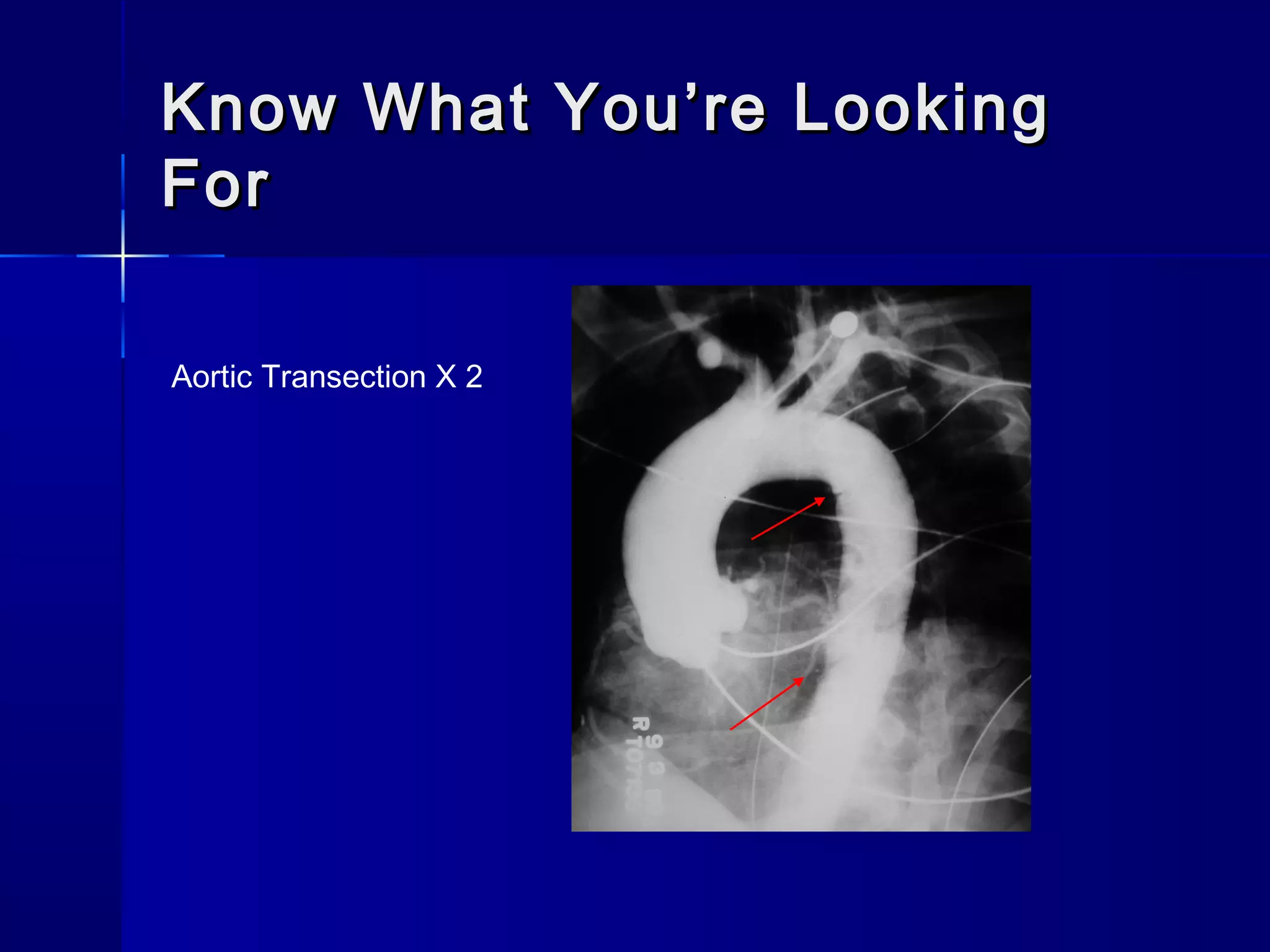 Know What You’re LookingKnow What You’re Looking
ForFor
Aortic Transection X 2
 