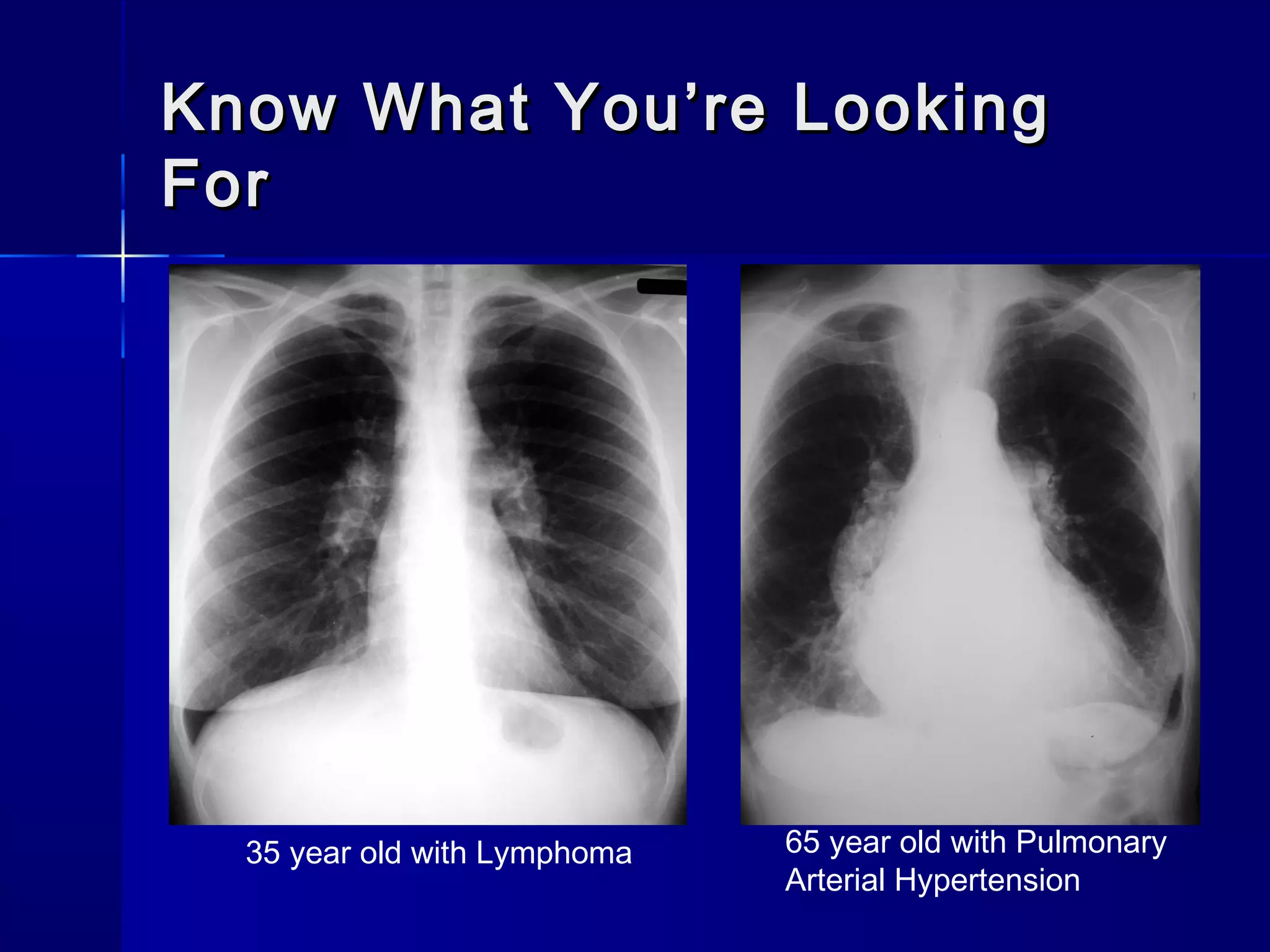 Know What You’re LookingKnow What You’re Looking
ForFor
35 year old with Lymphoma 65 year old with Pulmonary
Arterial Hypertension
 