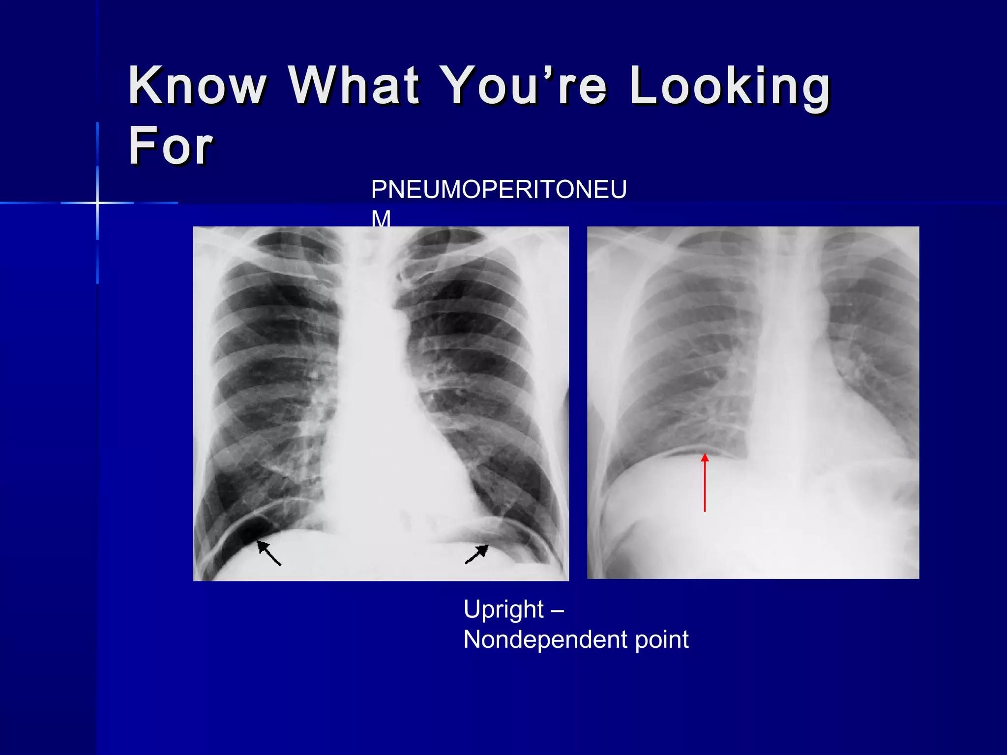 Know What You’re LookingKnow What You’re Looking
ForFor
PNEUMOPERITONEU
M
Upright –
Nondependent point
 