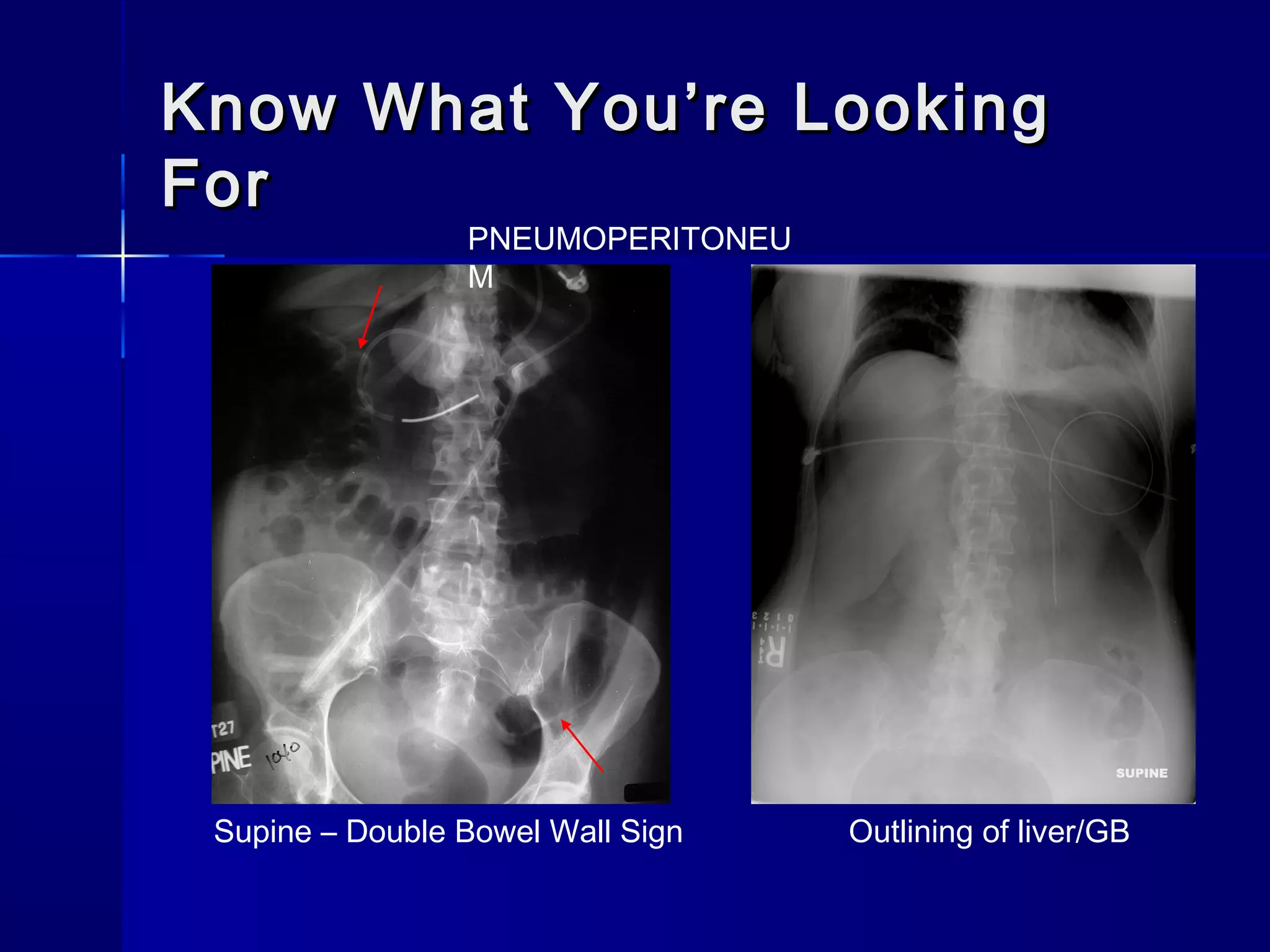 Know What You’re LookingKnow What You’re Looking
ForFor
Supine – Double Bowel Wall Sign
PNEUMOPERITONEU
M
Outlining of liver/GB
 