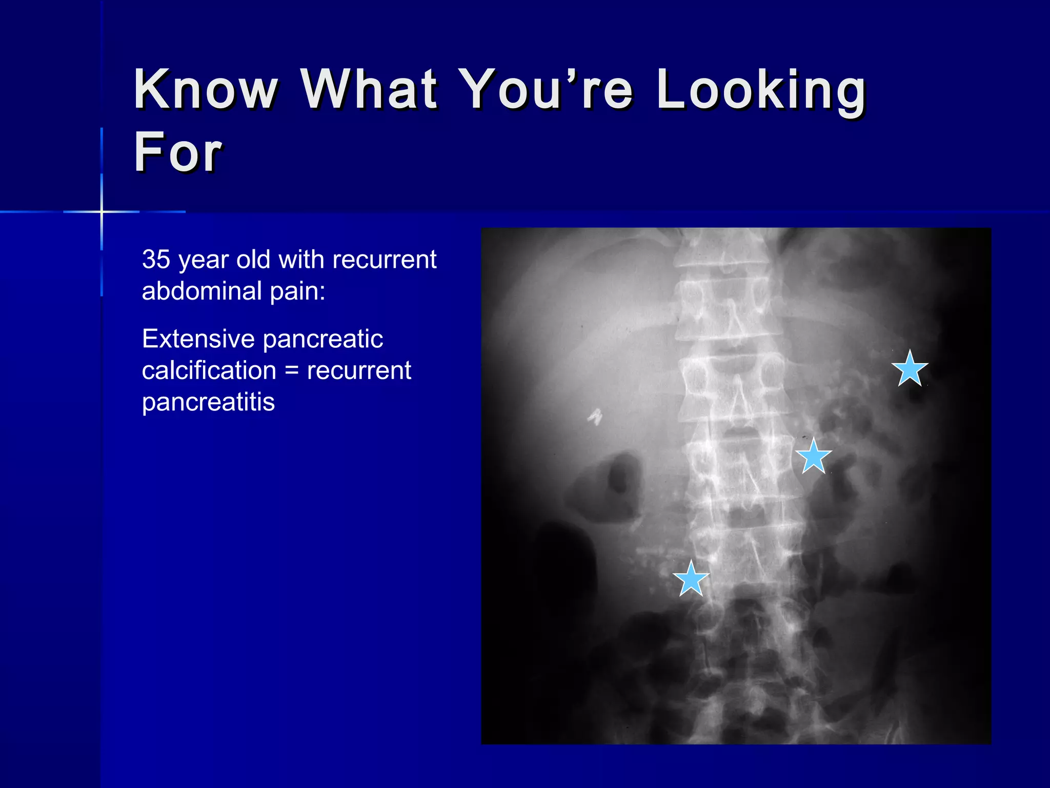 Know What You’re LookingKnow What You’re Looking
ForFor
35 year old with recurrent
abdominal pain:
Extensive pancreatic
calcification = recurrent
pancreatitis
 