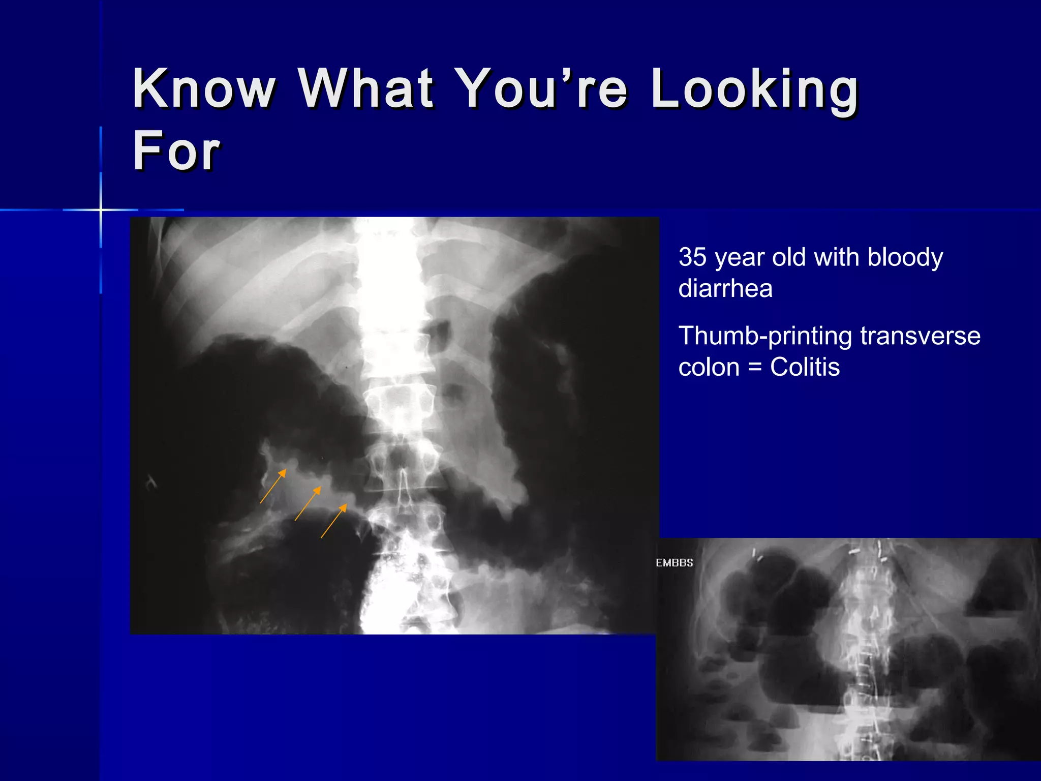 Know What You’re LookingKnow What You’re Looking
ForFor
35 year old with bloody
diarrhea
Thumb-printing transverse
colon = Colitis
 