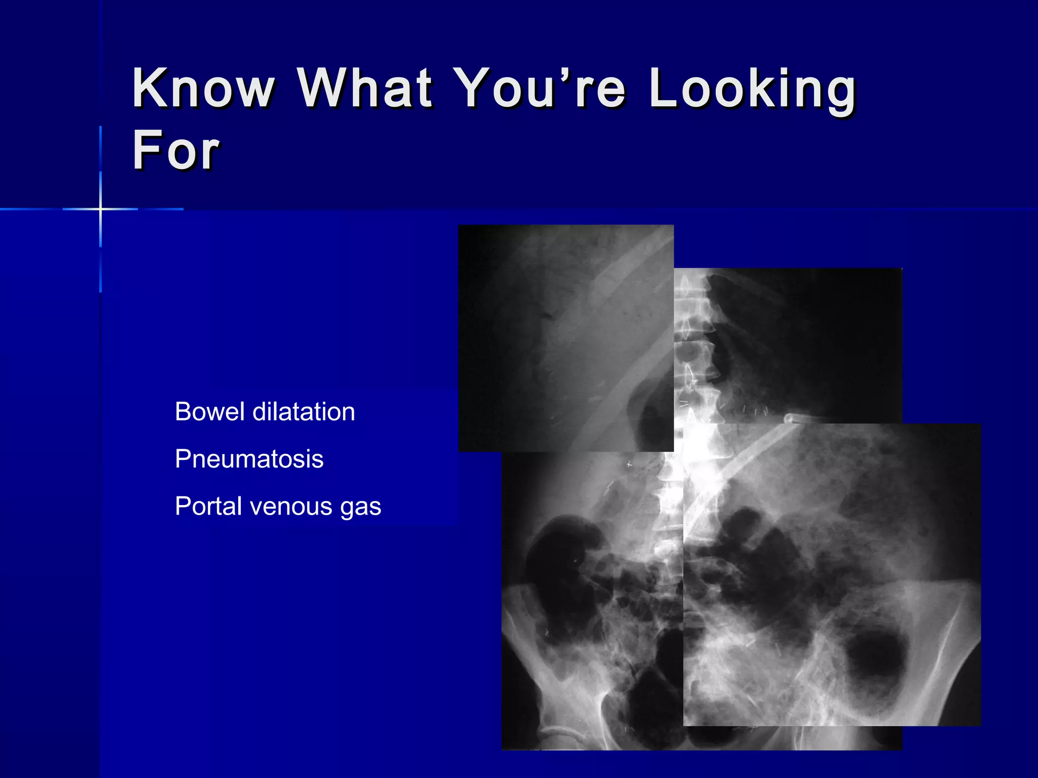 Know What You’re LookingKnow What You’re Looking
ForFor
60 year old with acidosis
and no bowel sounds,
suspect dead bowel
Bowel dilatation
Pneumatosis
Portal venous gas
 
