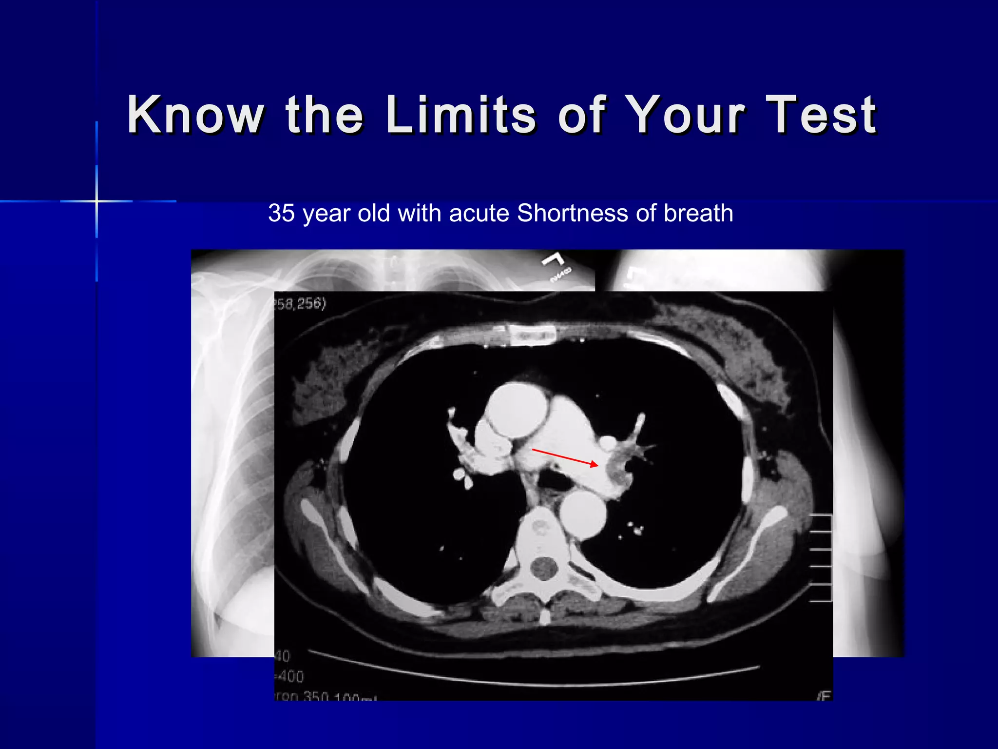 Know the Limits of Your TestKnow the Limits of Your Test
35 year old with acute Shortness of breath
 