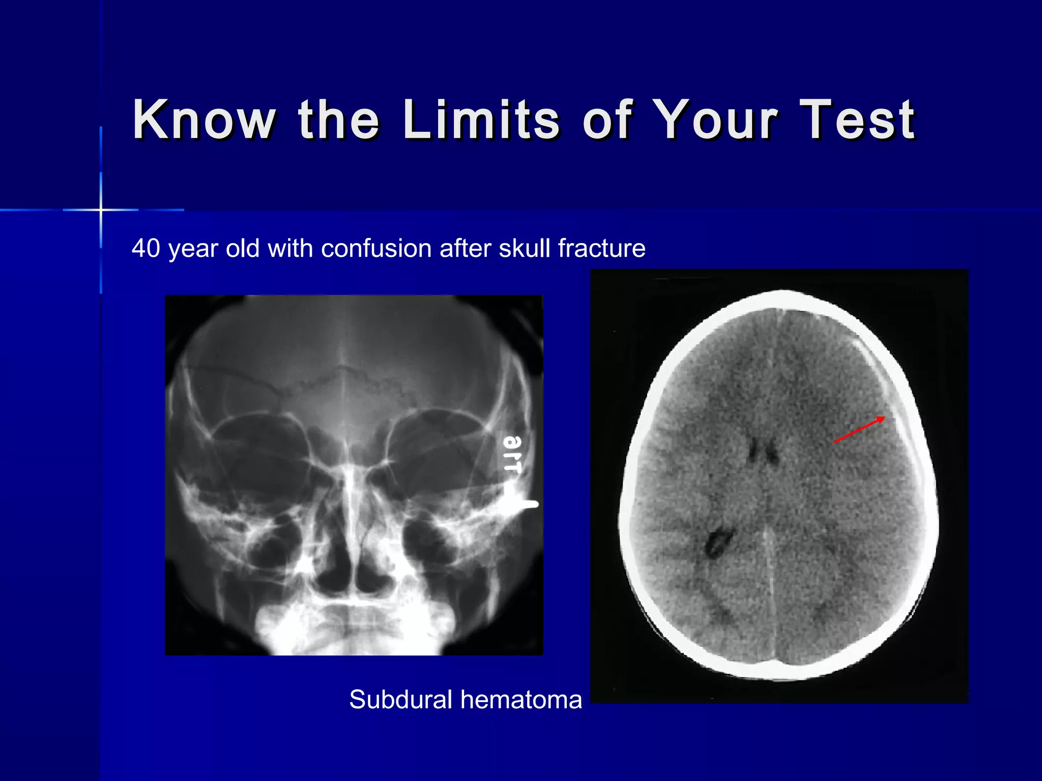 Know the Limits of Your TestKnow the Limits of Your Test
40 year old with confusion after skull fracture
Subdural hematoma
 