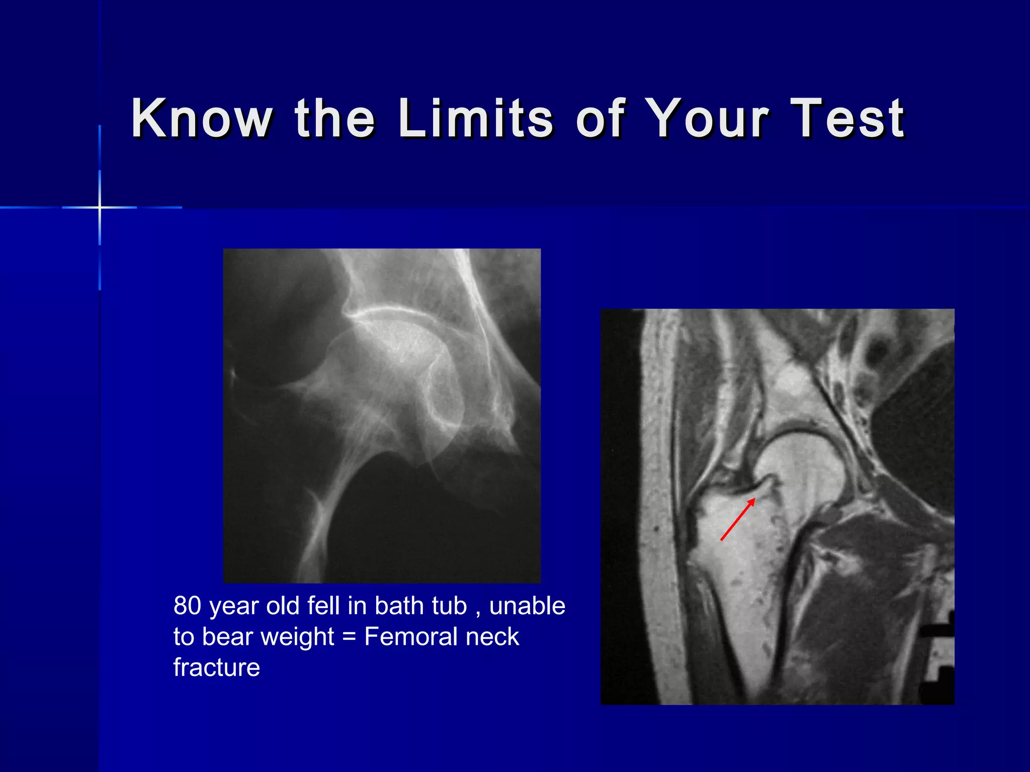 Know the Limits of Your TestKnow the Limits of Your Test
80 year old fell in bath tub , unable
to bear weight = Femoral neck
fracture
 