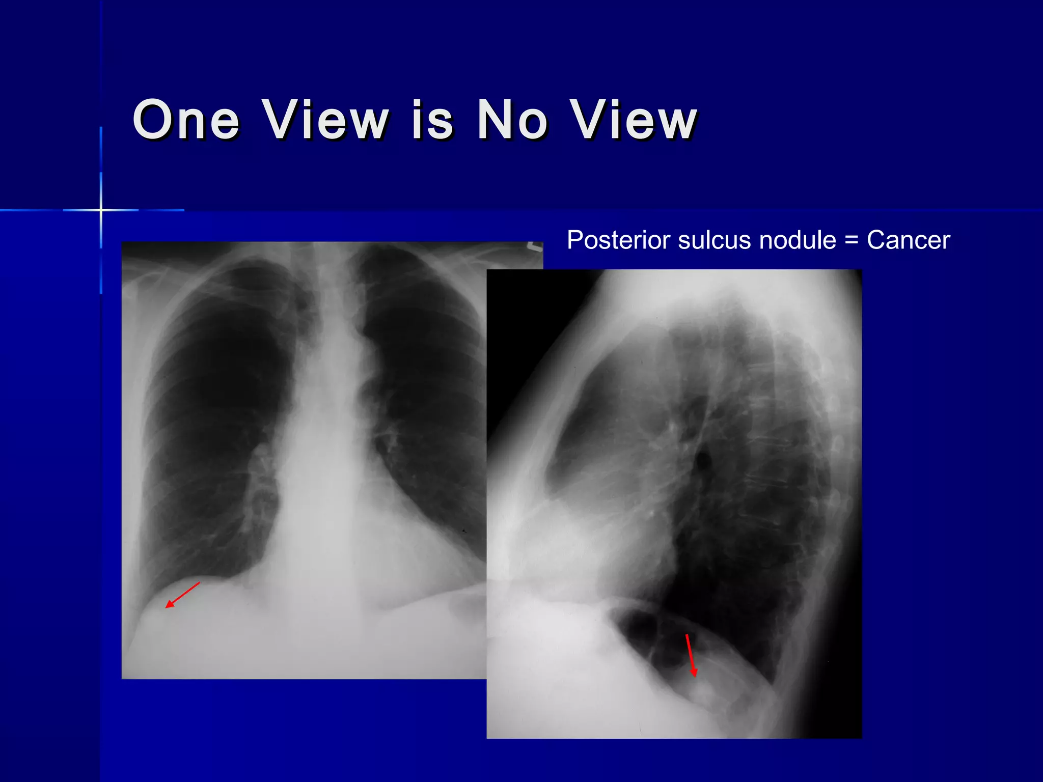 One View is No ViewOne View is No View
Posterior sulcus nodule = Cancer
 
