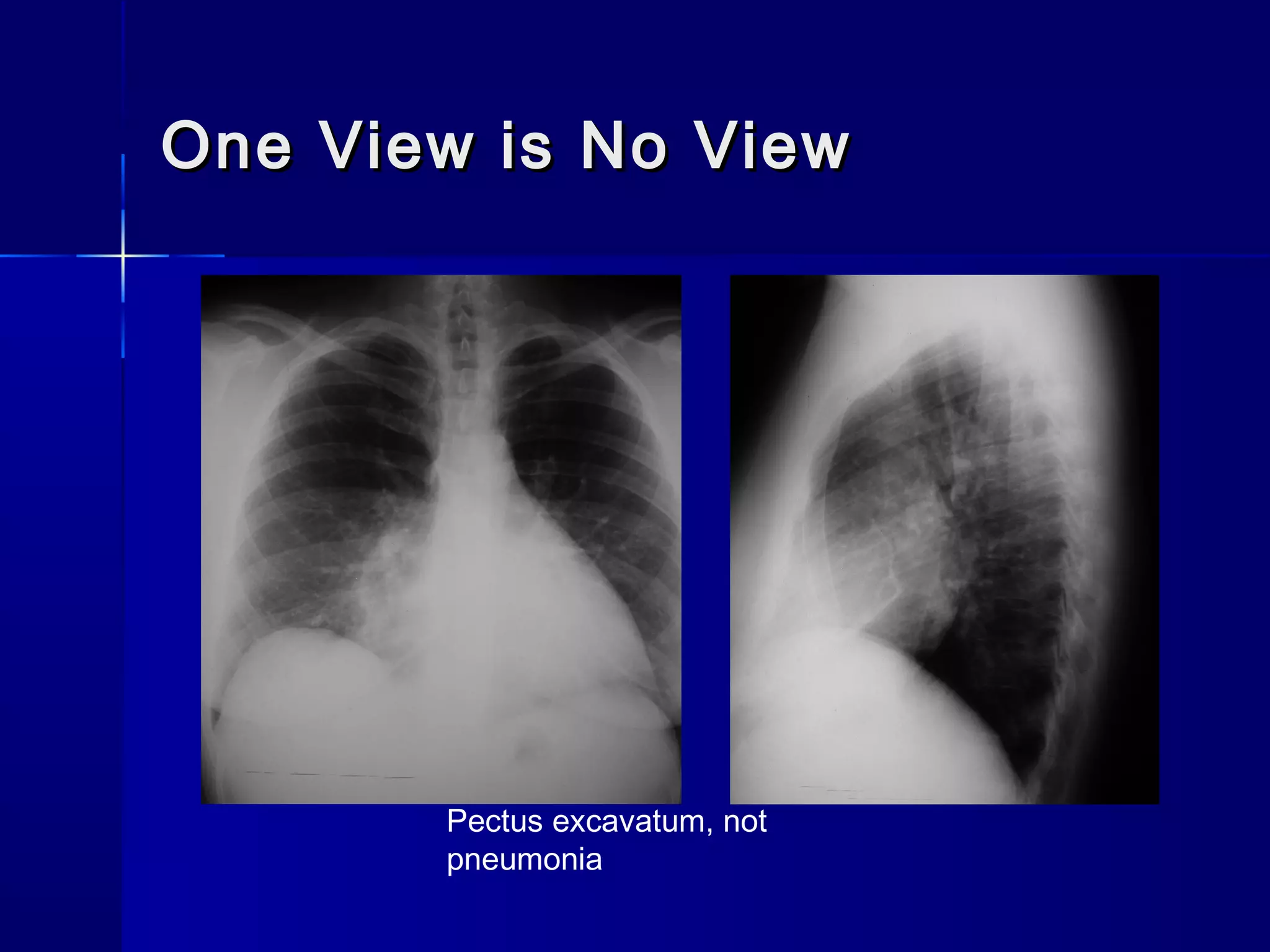 One View is No ViewOne View is No View
Pectus excavatum, not
pneumonia
 