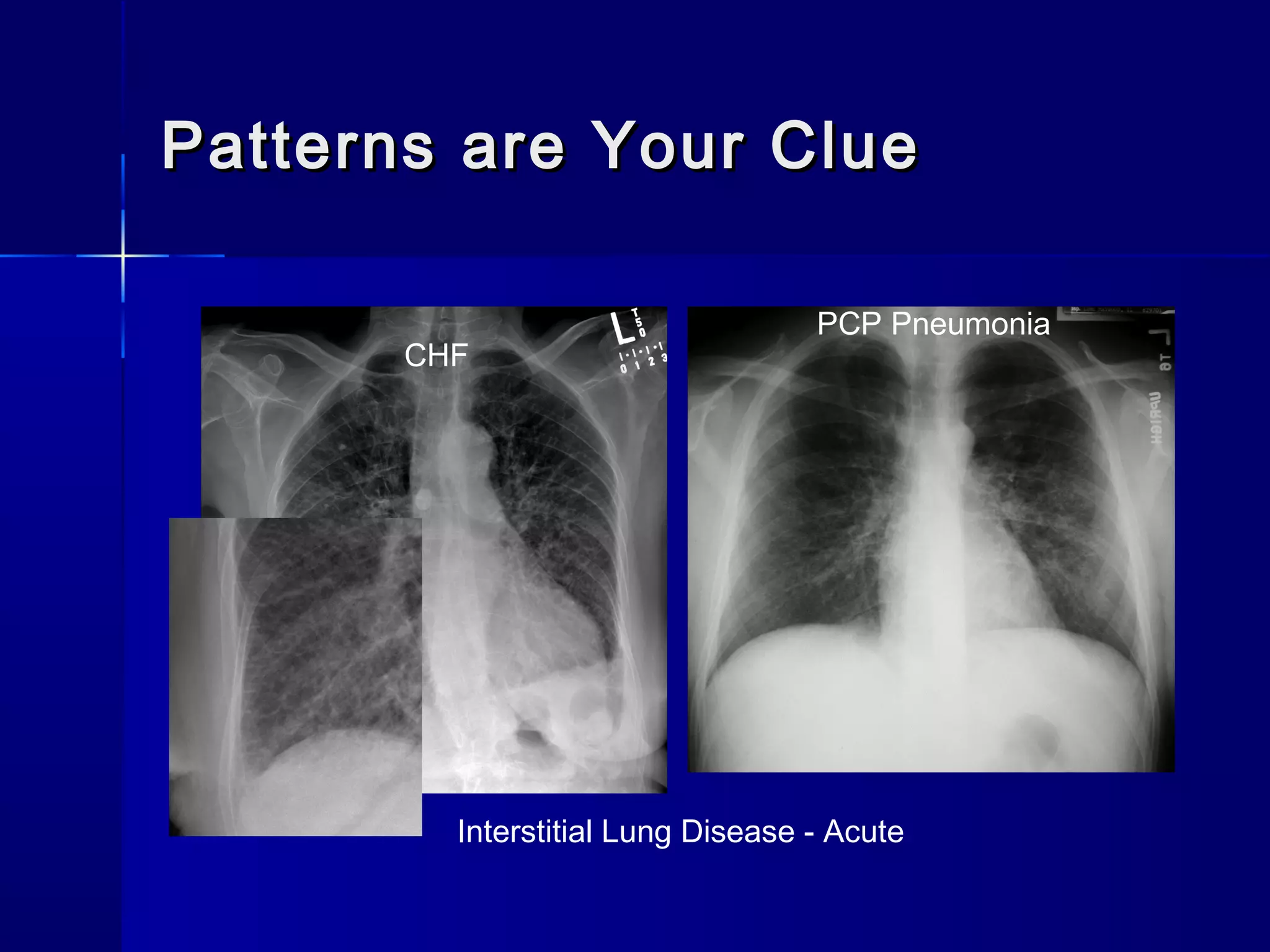 Patterns are Your CluePatterns are Your Clue
Interstitial Lung Disease - Acute
PCP Pneumonia
CHF
 