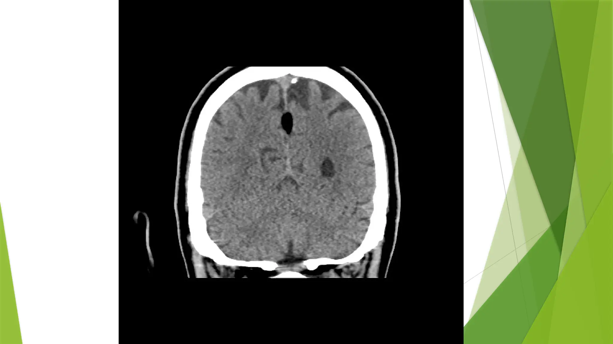 BASICS AND PRINCIPLES OF CT SCAN and windowing.pptx