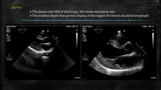 DEPTH:
The deeper the field of the image, the slower the frame rate
The smallest depth that permits display of the region of interest should be employed
 