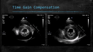Time Gain Compensation
 