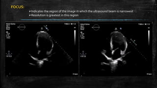 FOCUS:
Indicates the region of the image in which the ultrasound beam is narrowest
Resolution is greatest in this region
 