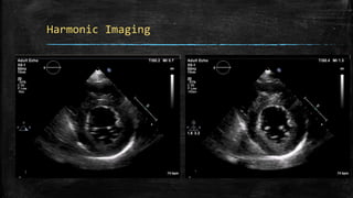 Harmonic Imaging
 
