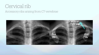 basics of chest xray with labelled diagram.pdf