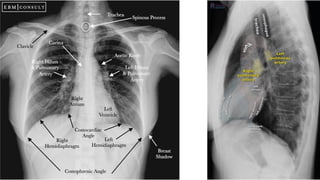 basics of chest xray with labelled diagram.pdf
