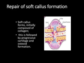 Repair of soft callus formation
• Soft callus
forms, initially
composed of
collagen;
• this is followed
by progressive
cartilage and
osteoid
formation.
 