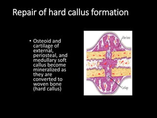 Repair of hard callus formation
• Osteoid and
cartilage of
external,
periosteal, and
medullary soft
callus become
mineralized as
they are
converted to
woven bone
(hard callus)
 