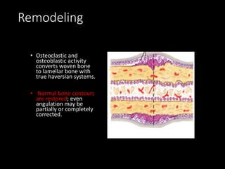Remodeling
• Osteoclastic and
osteoblastic activity
converts woven bone
to lamellar bone with
true haversian systems.
• Normal bone contours
are restored; even
angulation may be
partially or completely
corrected.
 