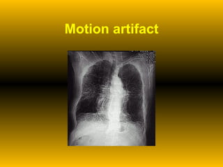 Motion artifact 