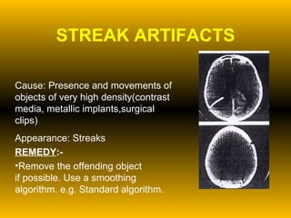 STREAK ARTIFACTS Cause: Presence and movements of objects of very high density(contrast media, metallic implants,surgical clips) Appearance: Streaks REMEDY :- Remove the offending object if possible. Use a smoothing algorithm. e.g. Standard algorithm. 