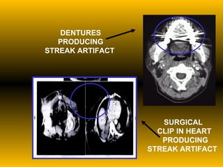 DENTURES PRODUCING STREAK ARTIFACT   SURGICAL  CLIP IN HEART  PRODUCING STREAK ARTIFACT 