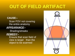 OUT OF FIELD ARTIFACT   CAUSE:- Scan FOV not covering the entire anatomy APPEARANCE :-   Shading/streaks REMEDY :-   Ensure that scan field of view is larger  than the object to be scanned 