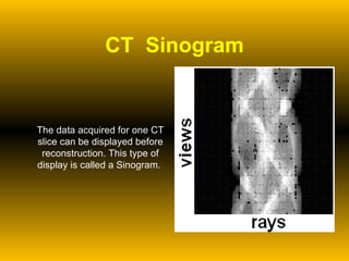 CT  Sinogram The data acquired for one CT slice can be displayed before reconstruction. This type of display is called a Sinogram.  