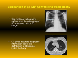 Comparison of CT with Conventional Radiography Conventional radiography suffers from the collapsing of 3D structures onto a 2D image CT gives accurate diagnostic information about the distribution of structures inside the body 