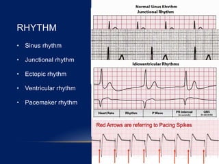 RHYTHM
• Sinus rhythm
• Junctional rhythm
• Ectopic rhythm
• Ventricular rhythm
• Pacemaker rhythm
 