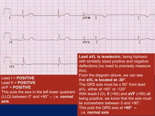 Lead I = POSITIVE
Lead II = POSITIVE
aVF = POSITIVE
This puts the axis in the left lower quadrant
(LLQ) between 0° and +90° – i.e. normal
axis
Lead aVL is isoelectric, being biphasic
with similarly sized positive and negative
deflections (no need to precisely measure
this).
From the diagram above, we can see
that aVL is located at -30°.
The QRS axis must be ± 90° from lead
aVL, either at +60° or -120°
With leads I (0), II (+60) and aVF (+90) all
being positive, we know that the axis must
lie somewhere between 0 and +90°.
This puts the QRS axis at +60° –
i.e. normal axis
 
