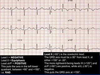 Lead I = NEGATIVE
Lead II = Equiphasic
Lead aVF = POSITIVE
This puts the axis in the left lower
quadrant, between +90° and +180°,
i.e. RAD.
Lead II (+60°) is the isoelectric lead.
The QRS axis must be ± 90° from lead II, at
either +150° or -30°.
The more rightward-facing leads III (+120°) and
aVF (+90°) are positive, while aVL (-30°) is
negative.
This puts the QRS axis at +150°.
 
