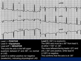 Lead I = POSITIVE
Lead II = Equiphasic
Lead aVF = NEGATIVE
This puts the axis in the left upper
quadrant, between 0° and -90°, i.e. normal
or LAD.
Lead II is neither positive nor negative
(isoelectric), indicating physiological LAD.
Lead II (+60°) is isoelectric.
The QRS axis must be ± 90° from lead II,
at either +150° or -30°.
The more leftward-facing leads I (0°) and
aVL (-30°) are positive, while lead III
(+120°) is negative.
This confirms that the axis is at -30°
 